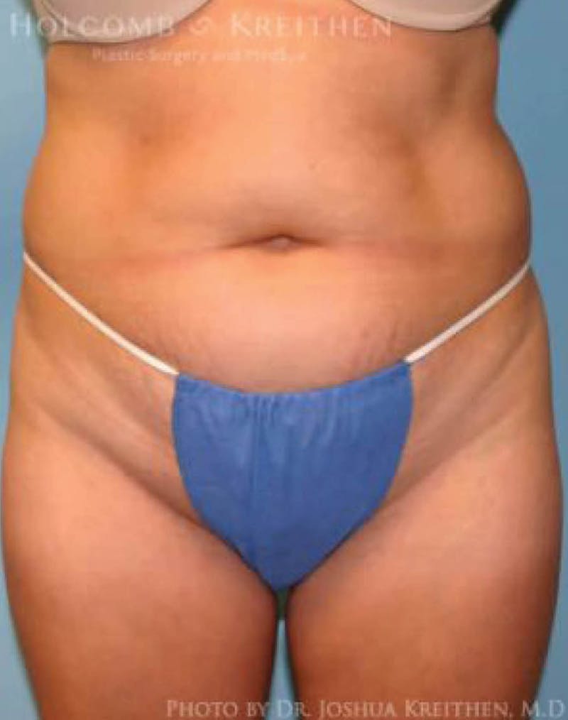 Liposuction Before & After Gallery - Patient 423563 - Image 1