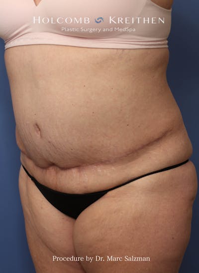 Liposuction Before & After Gallery - Patient 621503 - Image 1