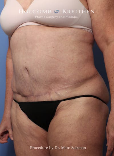 Liposuction Before & After Gallery - Patient 621503 - Image 2