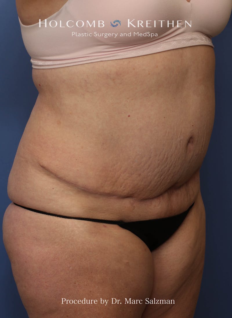Liposuction Before & After Gallery - Patient 621503 - Image 3