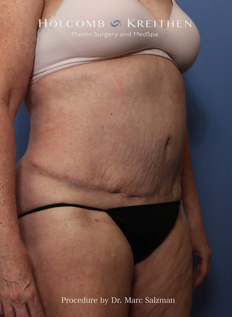 Liposuction Before & After Gallery - Patient 621503 - Image 4
