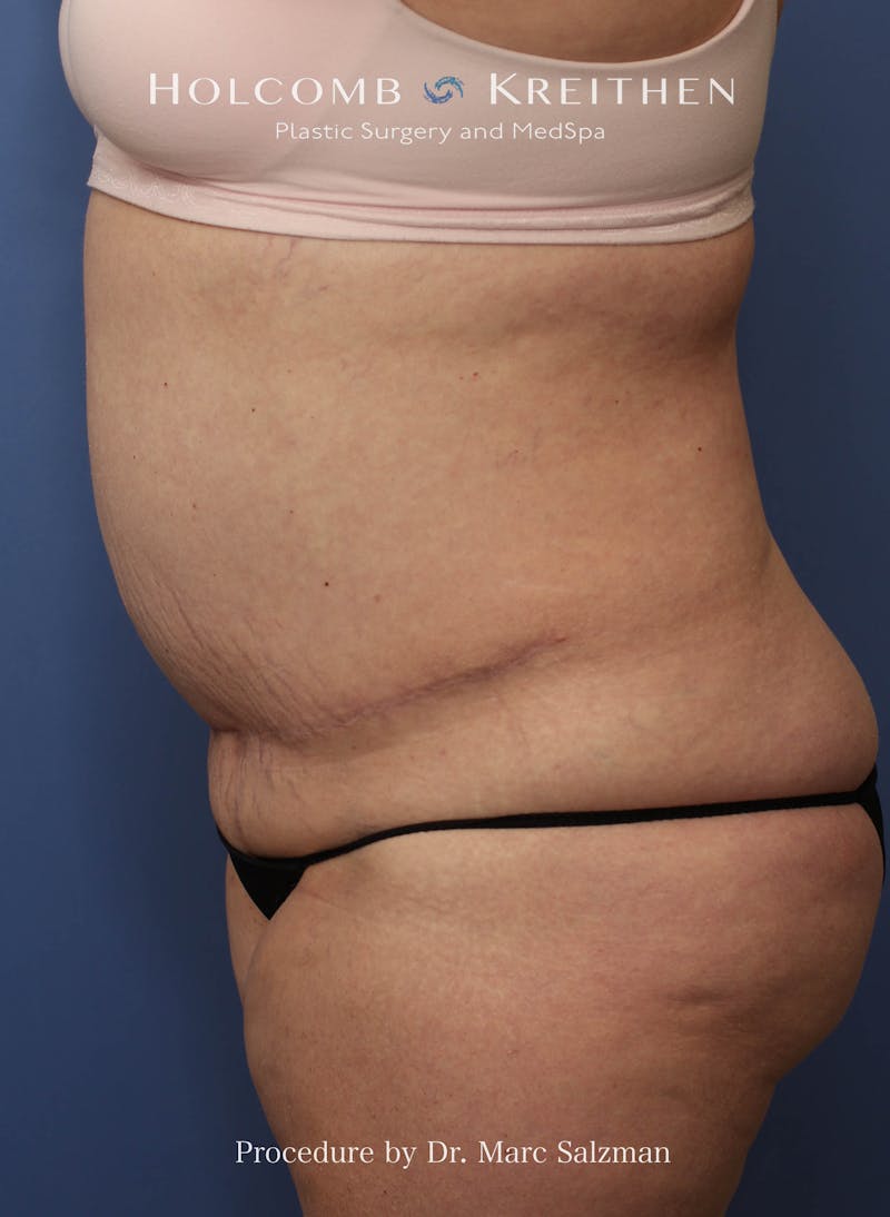 Liposuction Before & After Gallery - Patient 621503 - Image 5