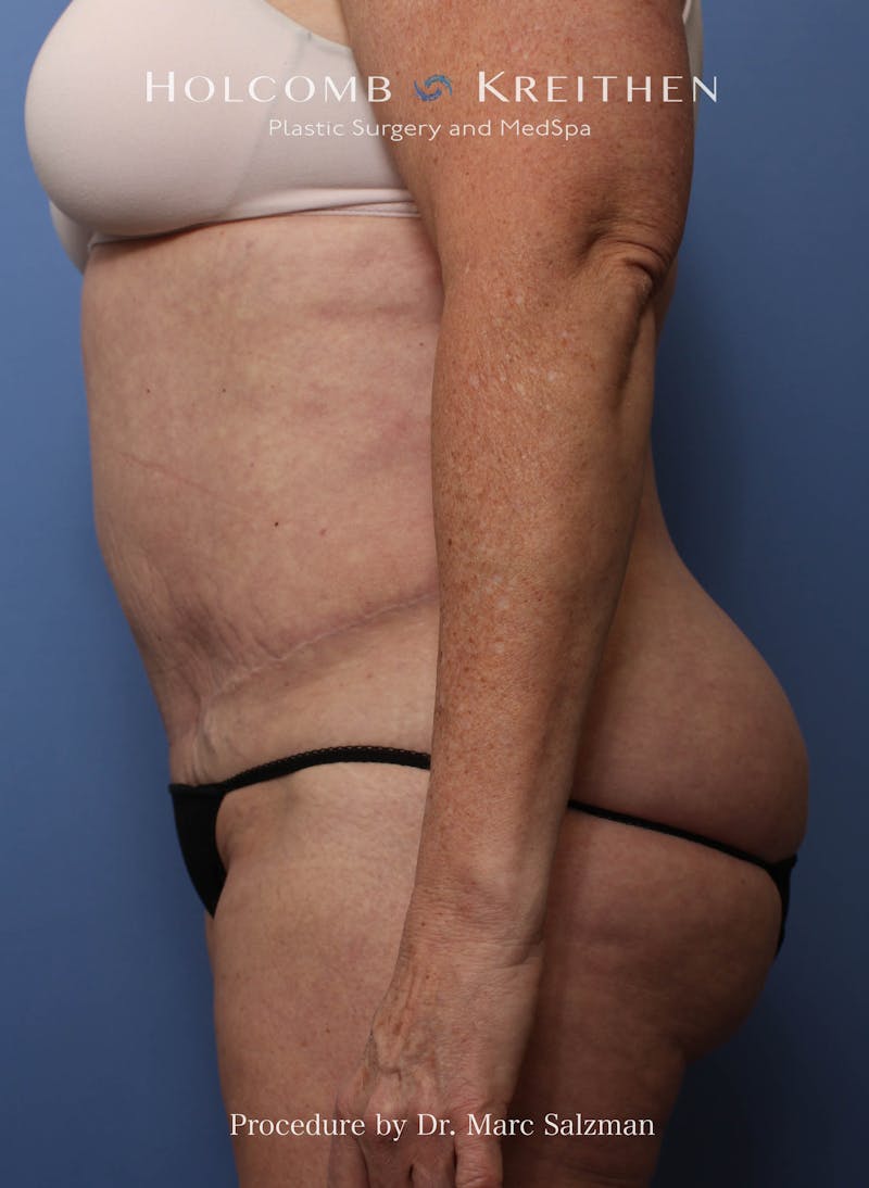 Liposuction Before & After Gallery - Patient 621503 - Image 6