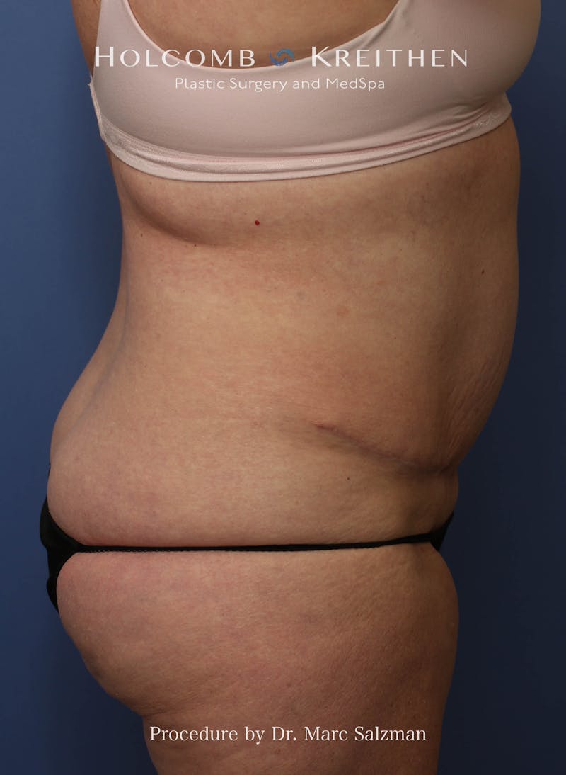 Liposuction Before & After Gallery - Patient 621503 - Image 7
