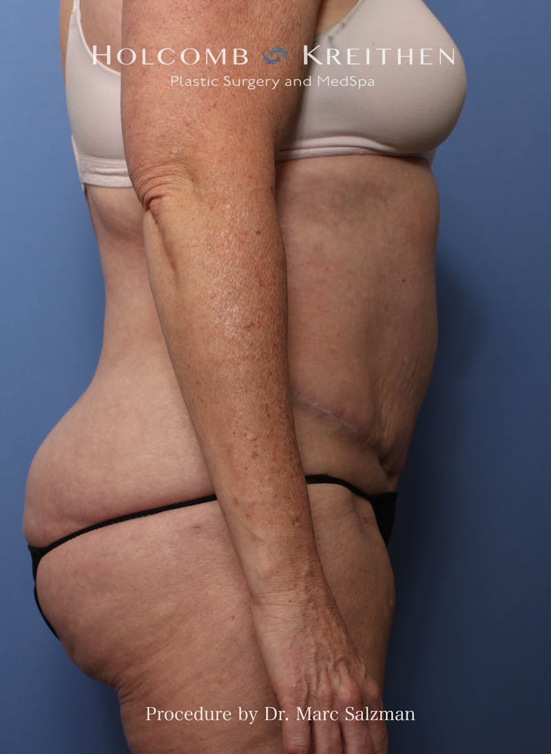 Liposuction Before & After Gallery - Patient 621503 - Image 8