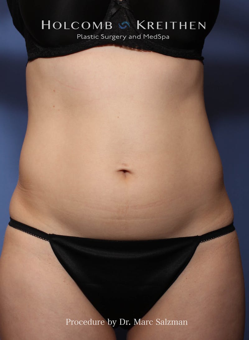 Liposuction Before & After Gallery - Patient 163958 - Image 1