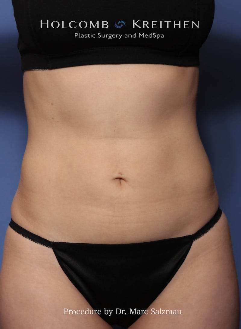 Liposuction Before & After Gallery - Patient 163958 - Image 2