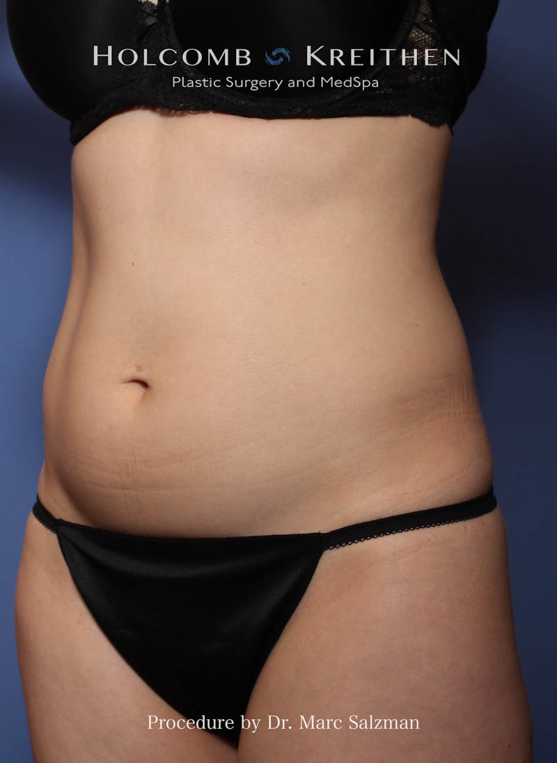 Liposuction Before & After Gallery - Patient 163958 - Image 3