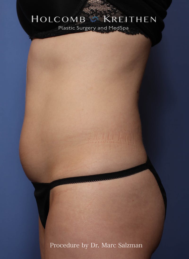 Liposuction Before & After Gallery - Patient 163958 - Image 5