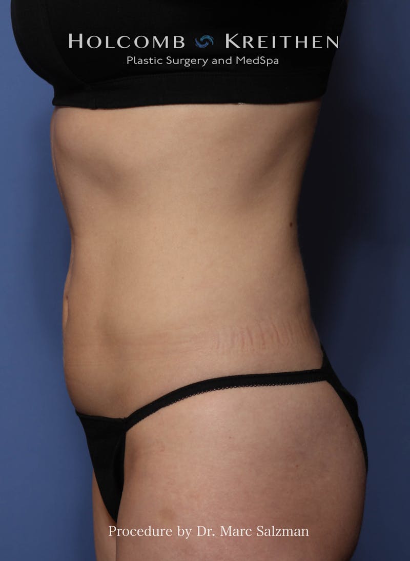 Liposuction Before & After Gallery - Patient 163958 - Image 6
