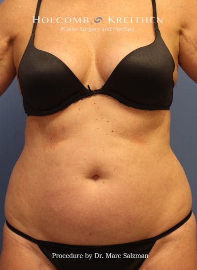 Liposuction Before & After Gallery - Patient 307606 - Image 1