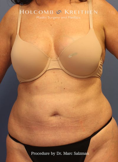 Liposuction Before & After Gallery - Patient 307606 - Image 2