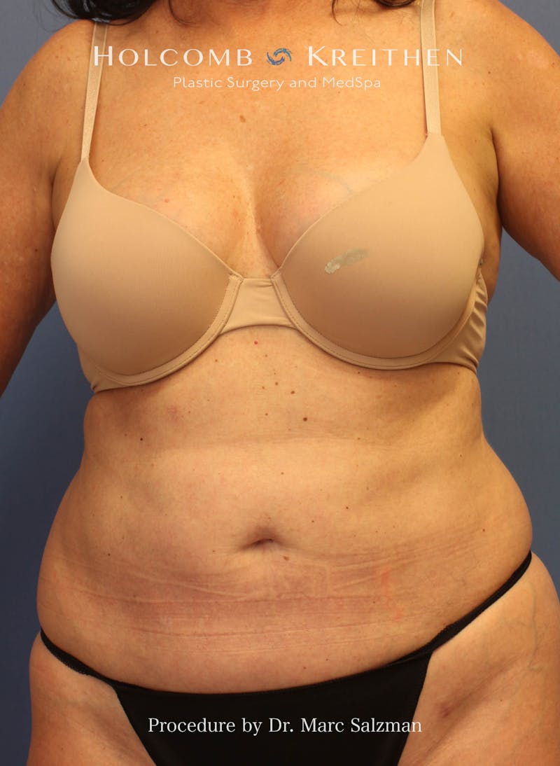 Liposuction Before & After Gallery - Patient 307606 - Image 2