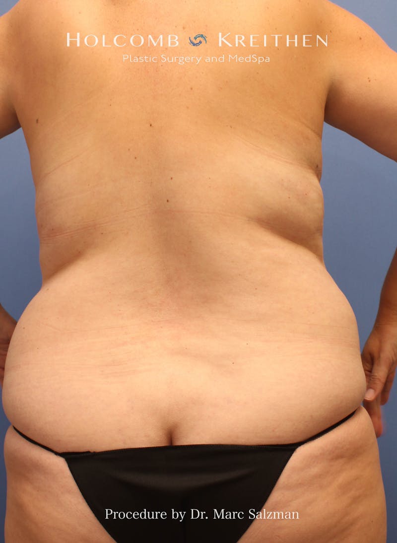 Liposuction Before & After Gallery - Patient 307606 - Image 3