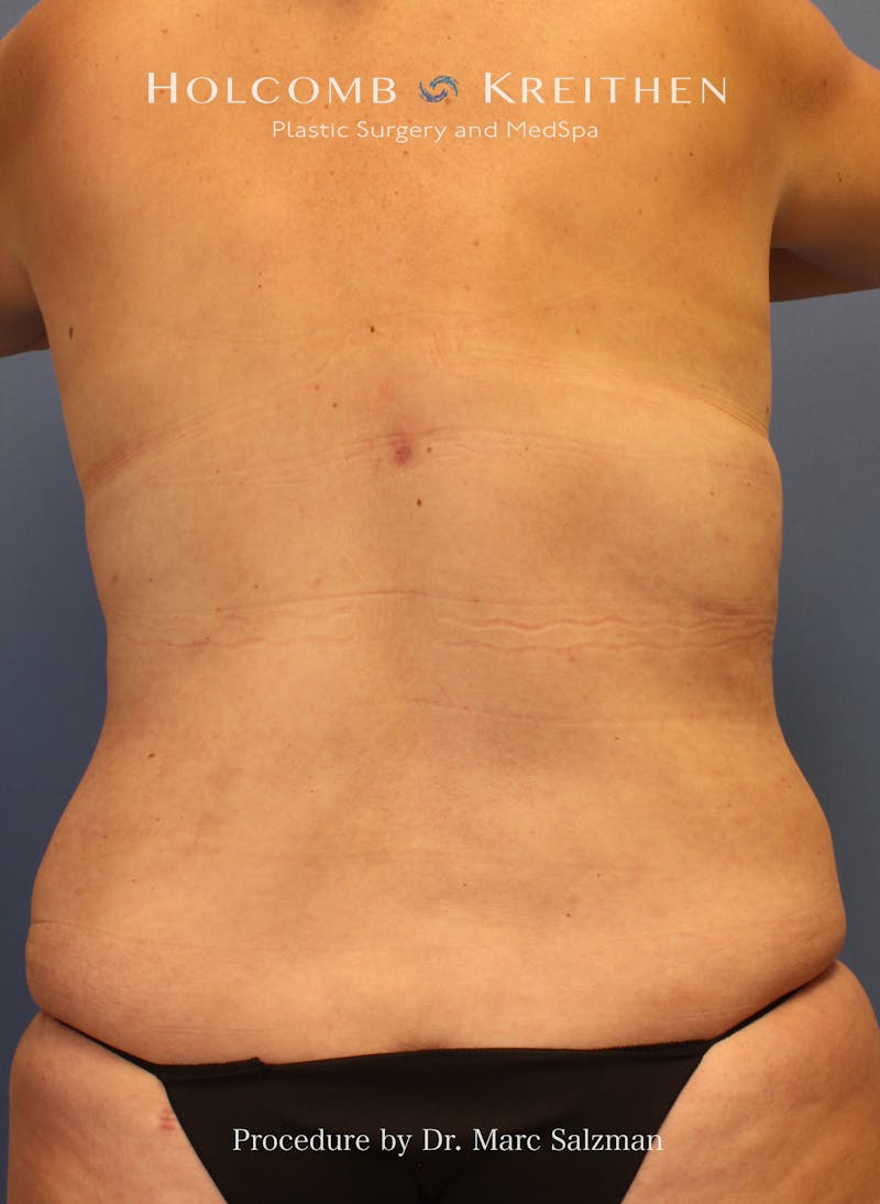 Liposuction Before & After Gallery - Patient 307606 - Image 4