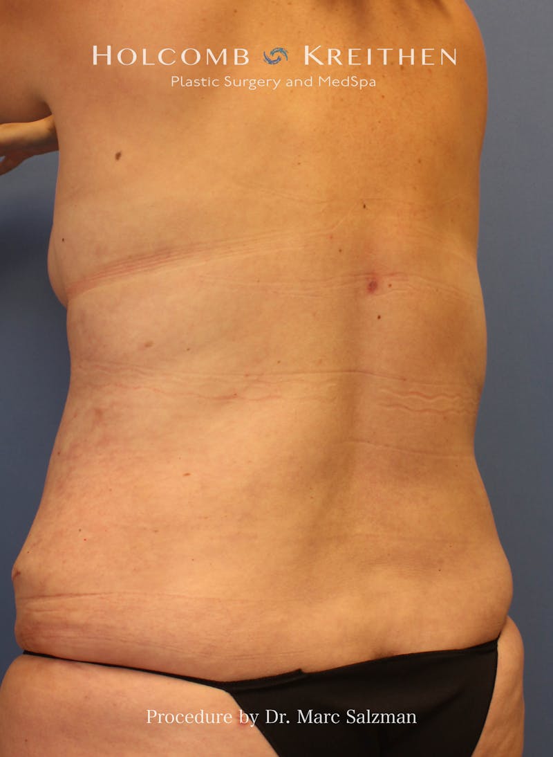 Liposuction Before & After Gallery - Patient 307606 - Image 6