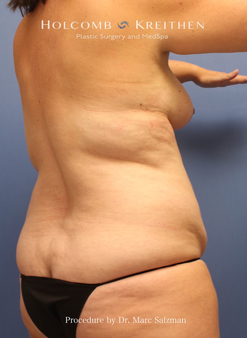 Liposuction Before & After Gallery - Patient 307606 - Image 7