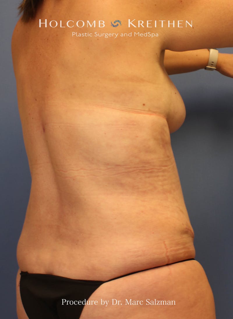 Liposuction Before & After Gallery - Patient 307606 - Image 8