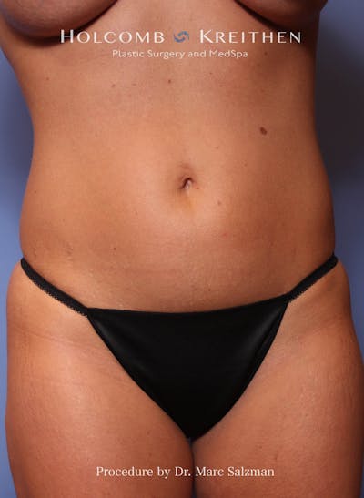 Liposuction Before & After Gallery - Patient 287370 - Image 1