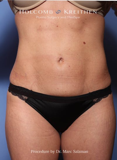 Liposuction Before & After Gallery - Patient 287370 - Image 2