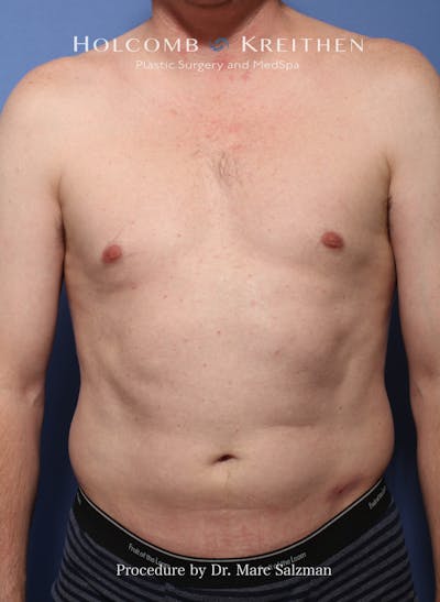 Liposuction Before & After Gallery - Patient 262454 - Image 1