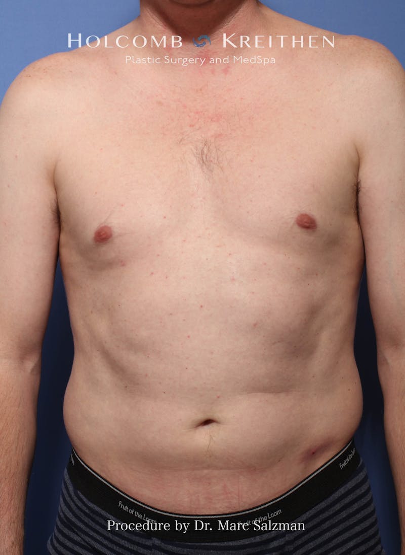 Liposuction Before & After Gallery - Patient 262454 - Image 1