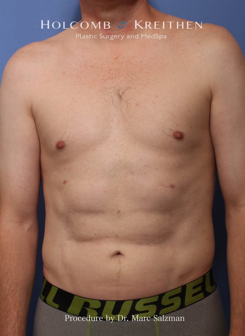 Liposuction Before & After Gallery - Patient 262454 - Image 2