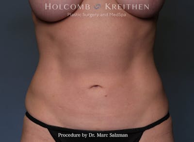 Liposuction Before & After Gallery - Patient 248372 - Image 2