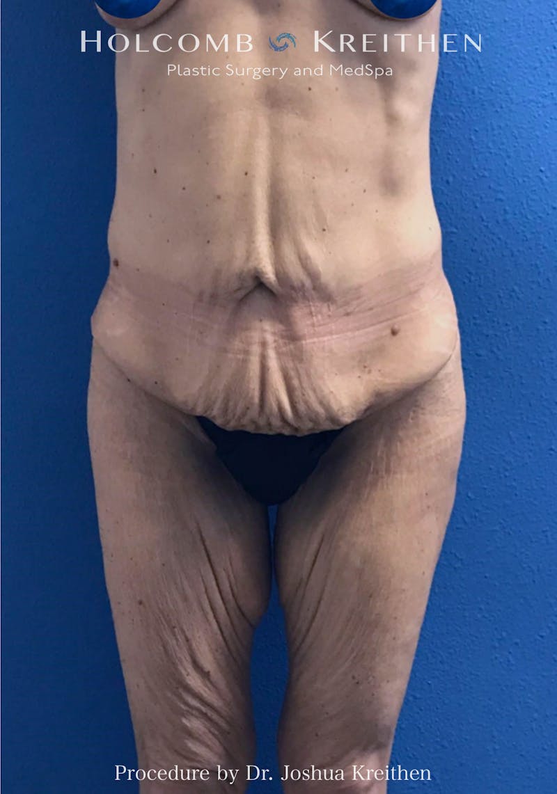 Lower Body Lift Before & After Gallery - Patient 265213 - Image 1