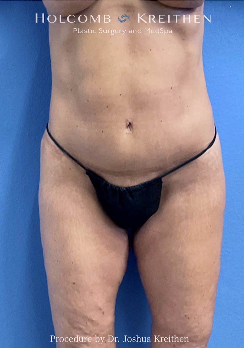 Lower Body Lift Before & After Gallery - Patient 265213 - Image 2