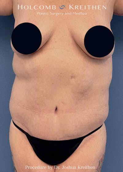 Lower Body Lift Before & After Gallery - Patient 225609 - Image 2