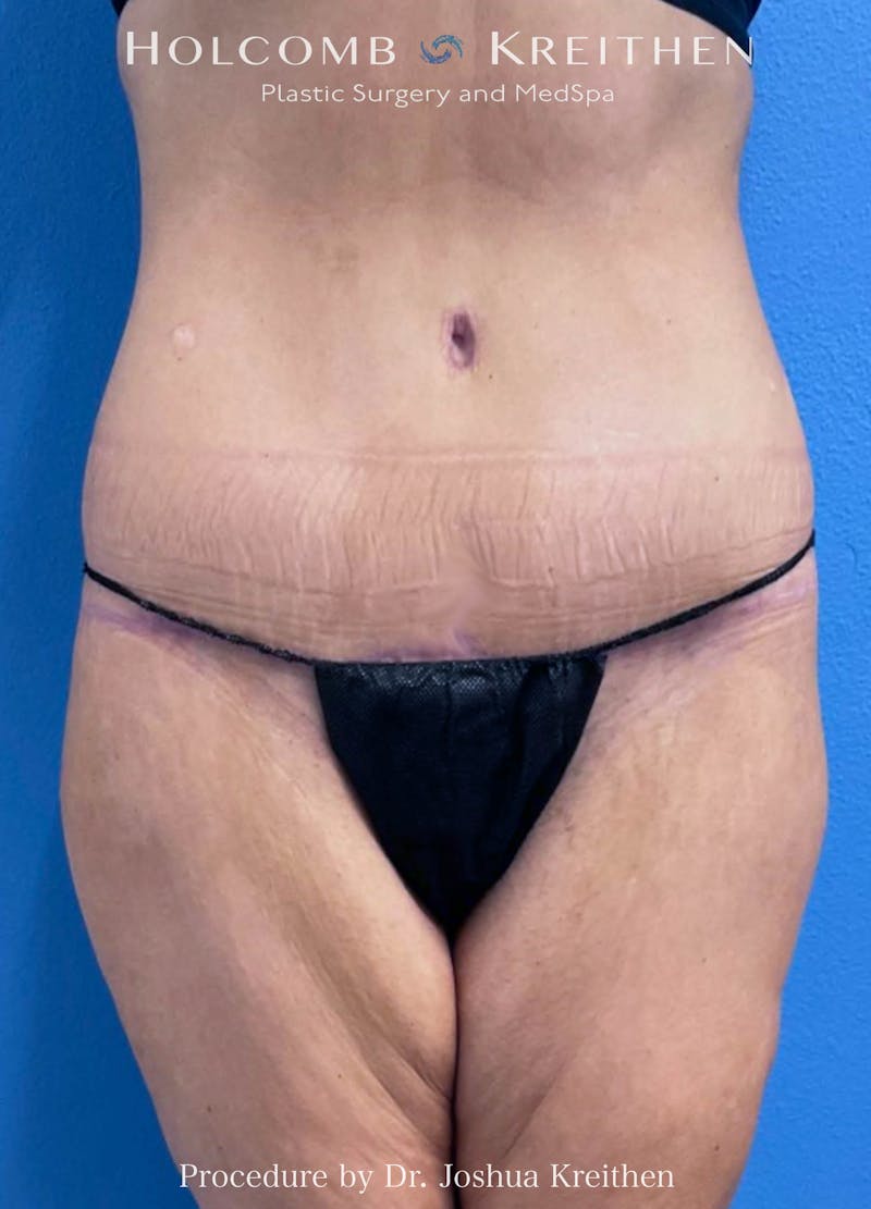 Lower Body Lift Before & After Gallery - Patient 234178 - Image 2