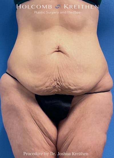 Lower Body Lift Before & After Gallery - Patient 234178 - Image 1