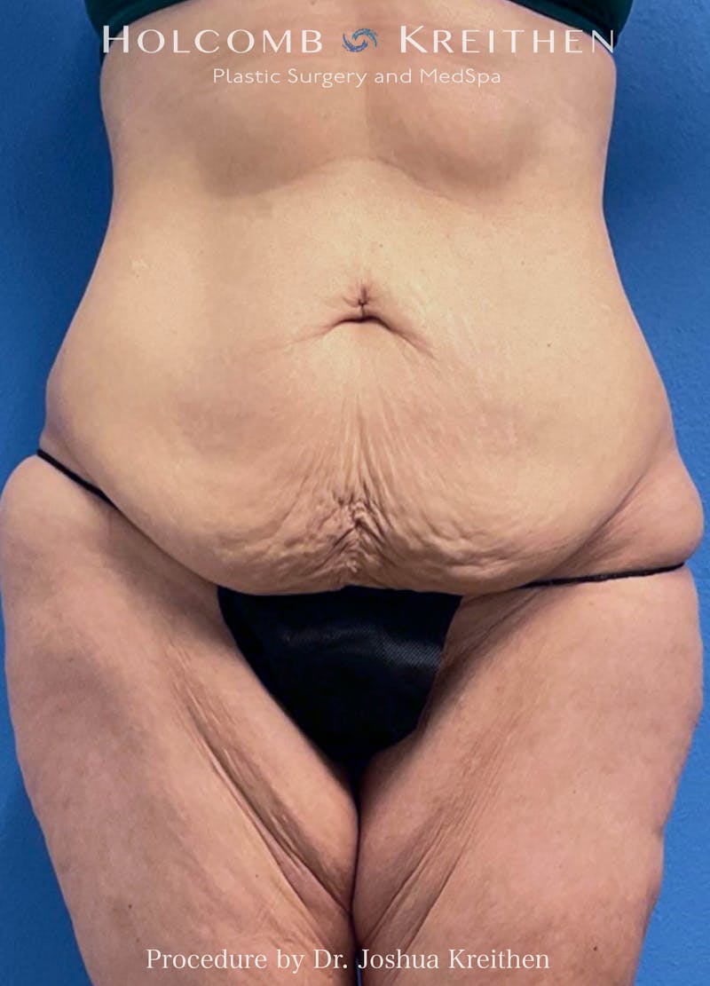 Lower Body Lift Before & After Gallery - Patient 234178 - Image 1