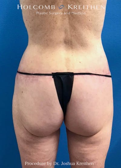Lower Body Lift Before & After Gallery - Patient 109537 - Image 2