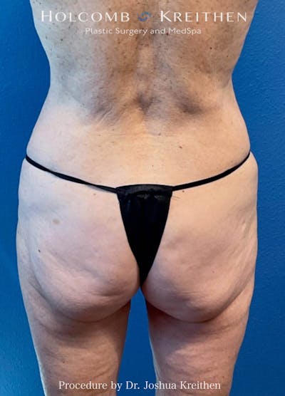 Lower Body Lift Before & After Gallery - Patient 109537 - Image 1