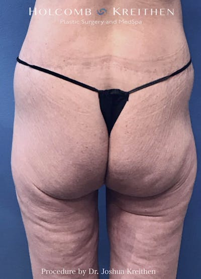Lower Body Lift Before & After Gallery - Patient 326146 - Image 2