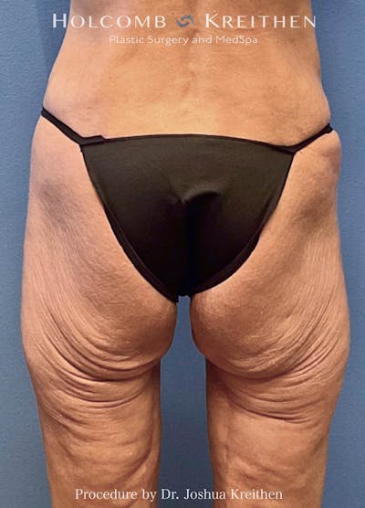 Lower Body Lift Before & After Gallery - Patient 326146 - Image 1