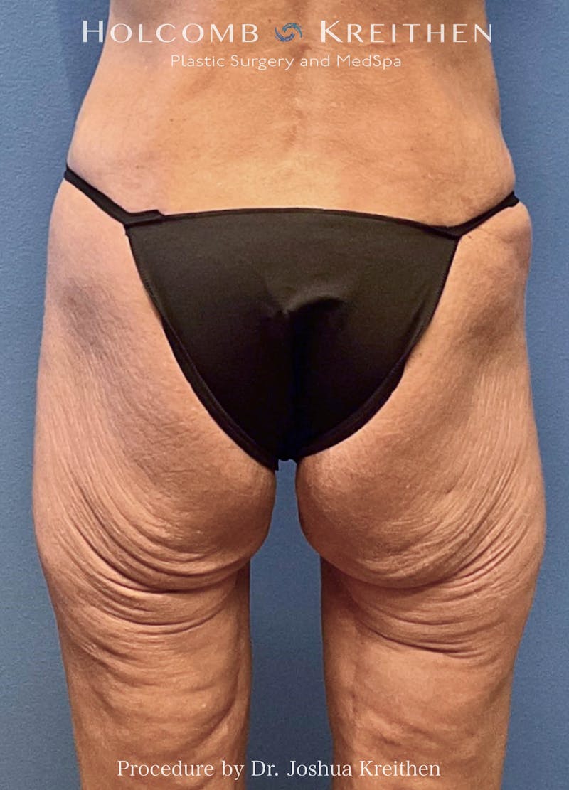 Lower Body Lift Before & After Gallery - Patient 326146 - Image 1