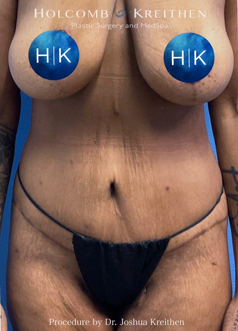 Lower Body Lift Before & After Gallery - Patient 522190 - Image 2