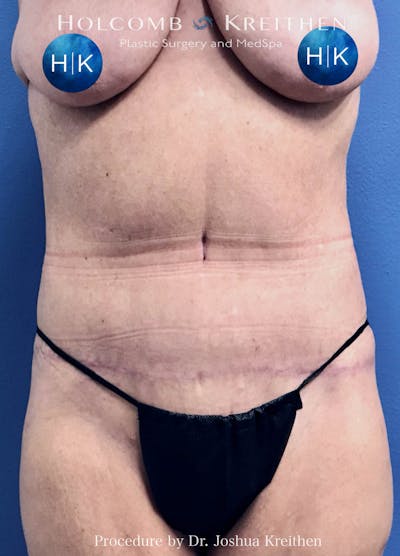 Lower Body Lift Before & After Gallery - Patient 349987 - Image 2