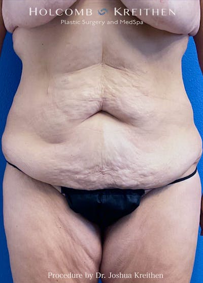 Lower Body Lift Before & After Gallery - Patient 224924 - Image 1