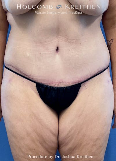 Lower Body Lift Before & After Gallery - Patient 224924 - Image 2
