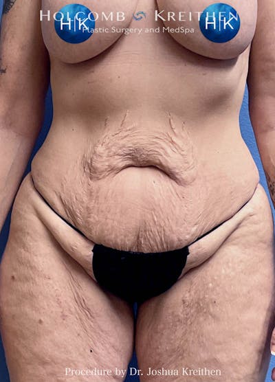 Lower Body Lift Before & After Gallery - Patient 146409 - Image 1