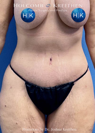 Lower Body Lift Before & After Gallery - Patient 146409 - Image 2
