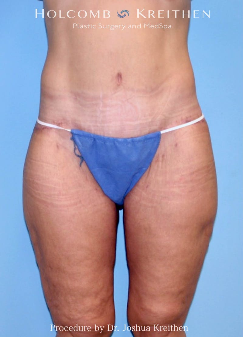 Lower Body Lift Before & After Gallery - Patient 438510 - Image 2