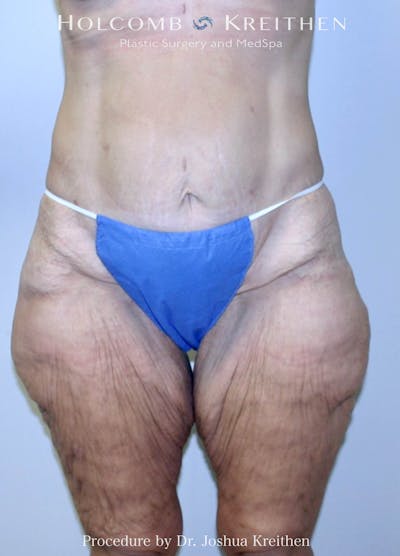Lower Body Lift Before & After Gallery - Patient 438510 - Image 1