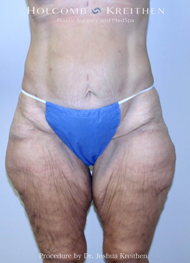 Lower Body Lift Before & After Gallery - Patient 438510 - Image 1