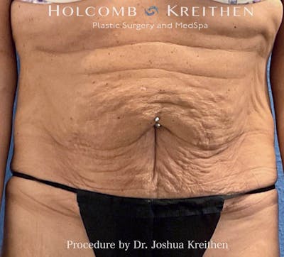 Lower Body Lift Before & After Gallery - Patient 119147 - Image 1