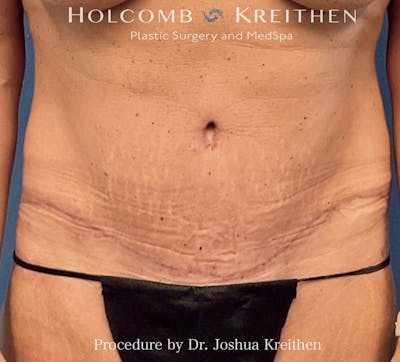 Lower Body Lift Before & After Gallery - Patient 119147 - Image 2